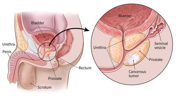 WHY SHOULD YOU BE WORRIED ABOUT PROSTATE CANCER?